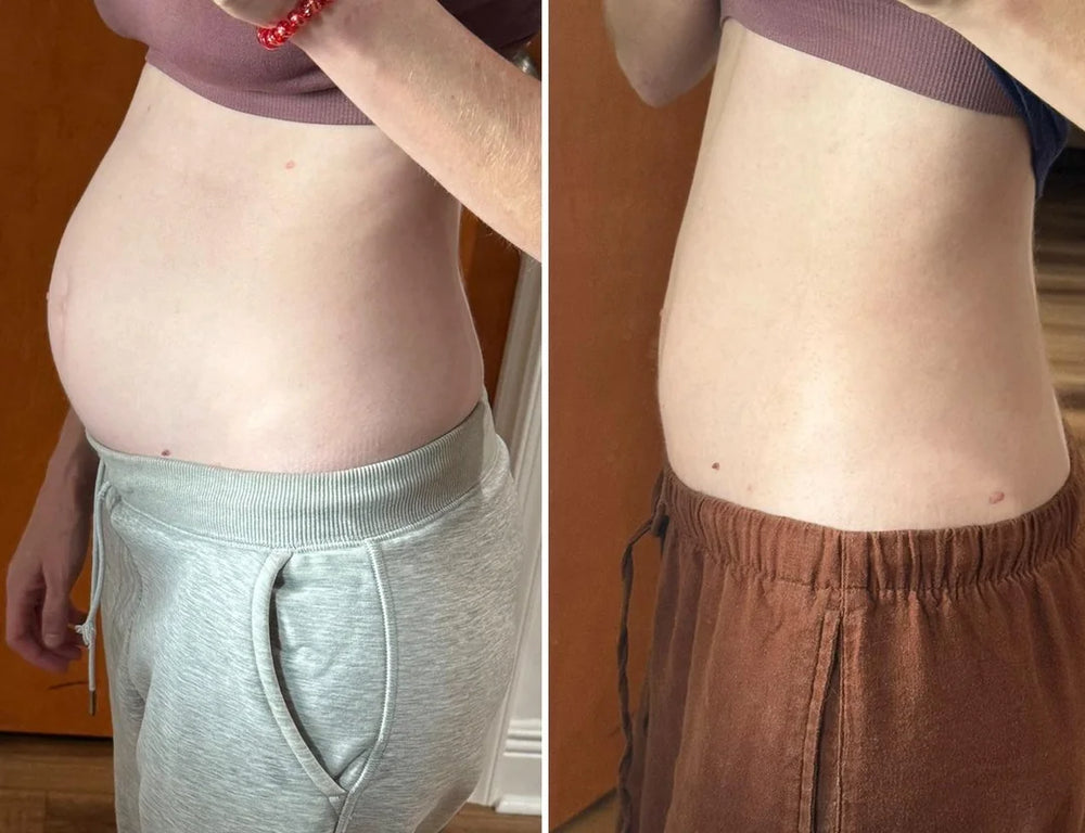 Comparación ilustrativa de abdomen inflamado y menos distendido