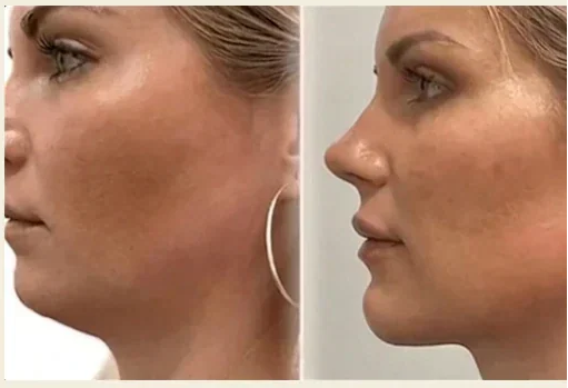Mujer observando su rostro ligeramente hinchado en el espejo